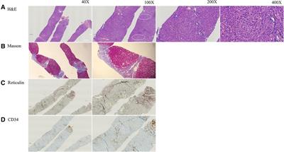 Case report: Novel DGUOK variants associated with idiopathic non-cirrhotic portal hypertension in a Han Chinese child